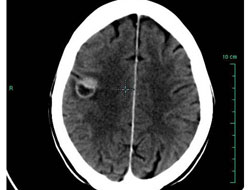 Ölümcül beyin tümörüne karşı aşı