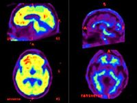 Alzheimer'ı erken tespit eden test